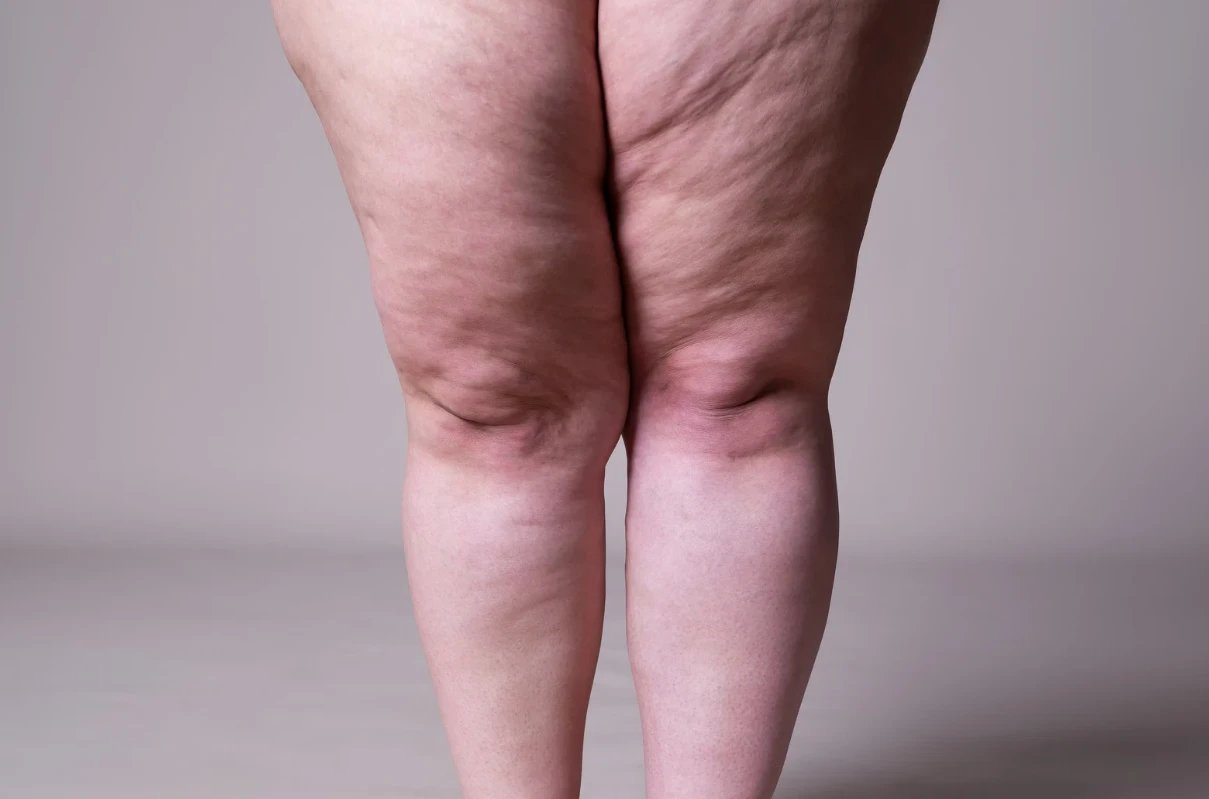 Saúde da mulher: Lipedema não é gordura comum: os sinais que fazem muitas mulheres passarem anos sem diagnóstico